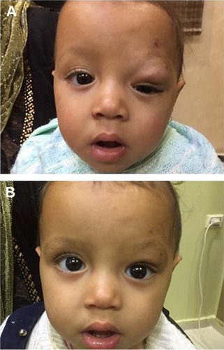 Figure 3 Infant, 3 months of age, with left-eye hemangioma.