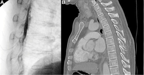 Figure 3 Thoracic epidural catheter with contrast shown on the X-ray (A) and computed tomography (CT) scan (B).