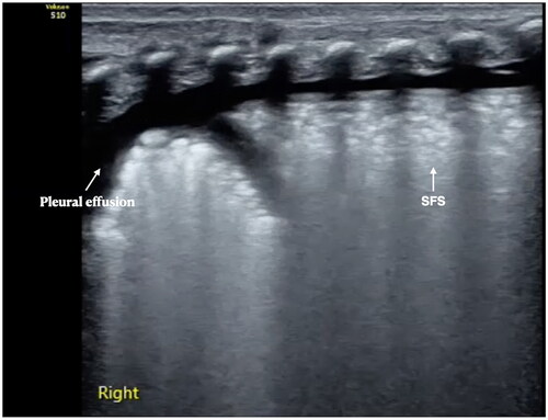 Figure 8. RDS complicated with pulmonary hemorrhage. A term RDS patient, bloody fluid emerging from the endotracheal tube during ventilator treatment. LUS examination revealed SFS-like lung consolidation with significant pleural effusion. The bloody fluid was withdrawn by thoracentesis. It was confirmed pulmonary hemorrhage due to RDS.