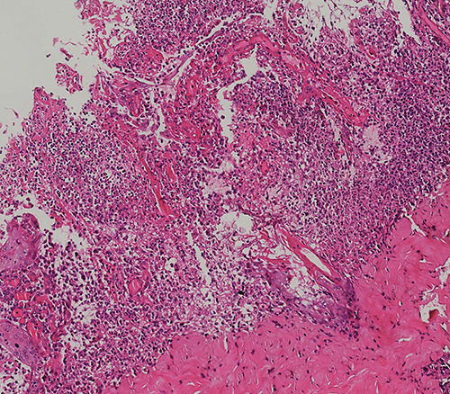 Figure 3 Histopathology of the skin lesion: A significant band-like infiltration of dense neutrophils in the superficial to mid-dermis, accompanied by a small amount of lymphocyte and neutrophil infiltration around the blood vessels in the dermal appendages. There is also dense proliferation of collagen fibers in the dermis (HEx200).