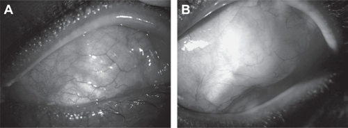 Figure 1 Slit lamp photographs of superotemporal bulbar conjunctiva of the left eye. (A) Before the intravitreal tPA injection, conjunctiva was flat over the Ahmed plate. Note the pericardium (Tutoplast, Costa Mesa, CA) and plate markings. (B) Two months following intravitreal tPA injection, there is a pseudocapsule over the functioning drainage device. Intraocular pressure is controlled with topical medications.