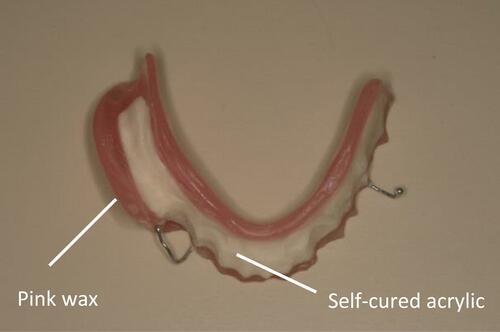 Figure 11 Mandibular occlusal rim.