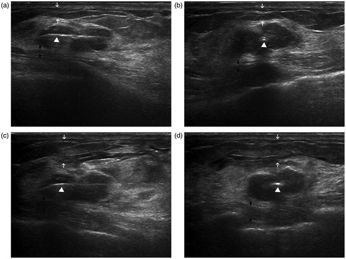 Figure 1. Intraoperative US in a 34-year-old woman demonstrates the accurate placement of the antenna and successful local anaesthesia. Longitudinal (a) and coronal (b) sonograms show the central placement of the antenna (arrow-head) within the tumour, indicating that the antenna was located in the centre of the tumour. After accurate placement of the antenna, 1% lidocaine was injected into subcutaneous space (white arrow) and retromammary space (black arrow). Longitudinal (c) and coronal (d) sonograms show the isolation belt was formed in subcutaneous space (white arrow) and retromammary space (black arrow).