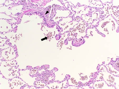 Figure 3 Histologic features of small airways disease. A section of lung tissue shows accumulation of macrophages with smoker’s pigment (arrow) within and around a respiratory bronchiole (arrow head).