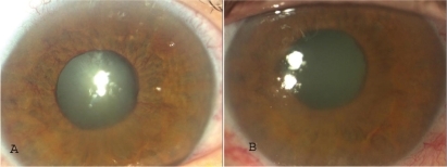 Figure 2 Case 3 A) On presentation, iris neovascularization. After three-month intravitreal injections of bevacizumab neovascularization disappears. B) Reappearance of neovascularization six months later.