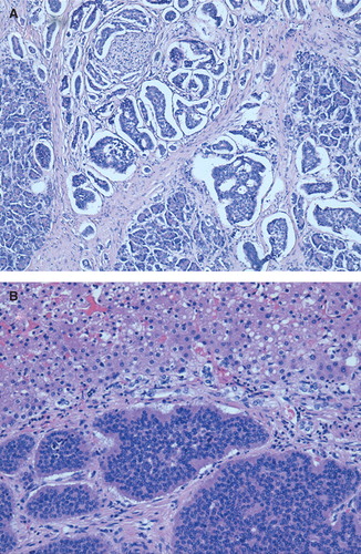 Figure 1. Well-differentiated neuroendocrine carcinoma of the pancreas (A), with liver metastases (B) (original magnification 400×).
