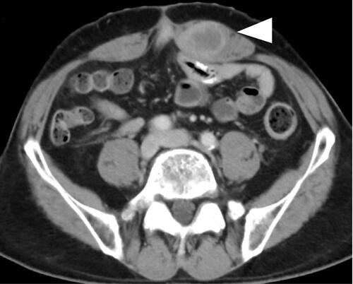 Figure 2 The enhanced CT in December 2017 showed the mass of 38mm with dyeing ring form in the left rectus abdominis muscle. The mass was located near the ileostomy closure scar. The triangle points to the tumor.
