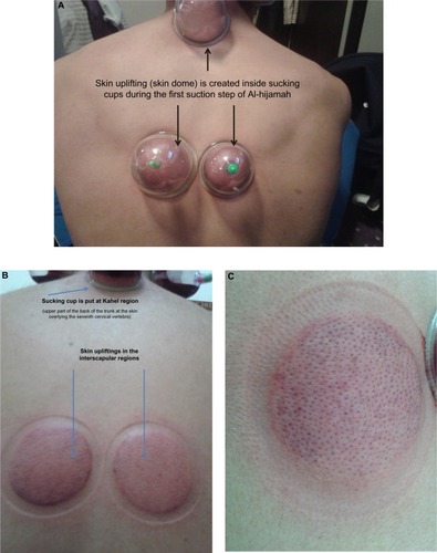 Figure 2 First step of Al-hijamah (first suction step).