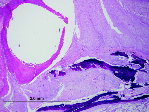 Figure 2.  Central circular core of necrotic tissue surrounding the removed plastic bit (empty space), necrotic bone within the beak, and papillary projections of hyperplastic epithelium.