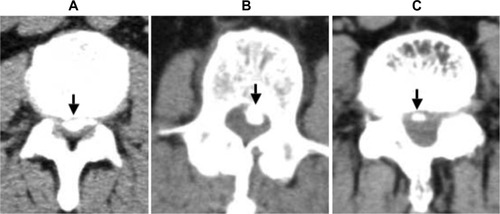 Figure 1 Abdominal and pelvic CT scans of patients with OPLL.