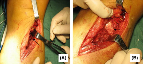 Figure 2. (A) Exposing fracture of tibial plateau and bone defect. (B) Implanting Nano-HA artificial bone.