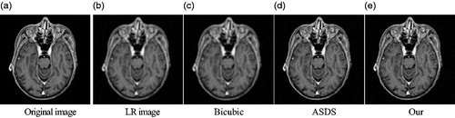 Figure 6. Comparison of the reconstructed images of various methods for noisy medical image (Equation1(1) x≈Φα(1) ) (a) Original image (b) LR image (c) Bicubic (d) ASDS (e) Our.