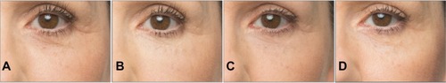 Figure 1 A 57-year-old female patient with a Merz Aesthetics Scale® score of 2 for infraorbital hollow at baseline (A) received supraperiosteal injections of 0.7 mL CPM® hyaluronic acid gel per side. (B) 3 months, (C) 6 months, and (D) 9 months after treatment.® Dr. Huber-Vorländer.