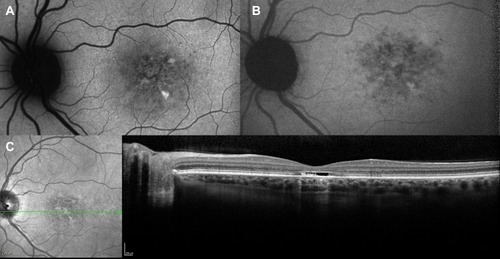 Figure 5 Foveal cavitation in STGD1. Short wavelength autofluorescence (A) and near-infrared autofluorescence (B) show macular mottling of RPE. In OCT (C), foveal cavitation appears as a hollow subfoveal space due to focal loss of RPE and photoreceptors with backscattering effect. External limiting membrane is preserved.