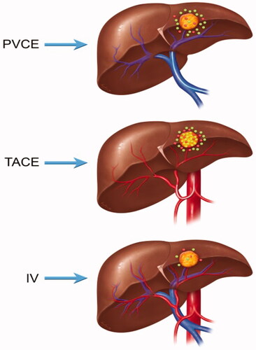 Figure 7. Schematic representation of the different routes of administration and their corresponding biodistribution at 24 h after treatment in tumor-bearing WAG/Rjj rats. Green dots represents IRI, while red dots represents SN38.