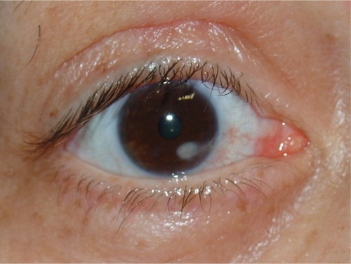 Figure 3 Corneal ulceration and leukoma caused by chronic corneal exposition.