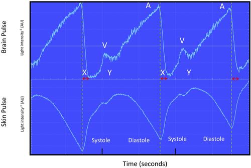 Figure 2 Recording of simultaneous brain oximeter and conventional forehead PPG waveforms (660 nm wavelength shown) during normoxia from subject 3. The dashed lines represent the start of each skin pulse. The brain and forehead skin PPG waveforms were different. The brain oximeter PPG waveform was similar in shape and timing to a central venous pressure waveform, with phases consistent with A, X, V and Y waves. The skin PPG waveform was quite distinct with the shape and timing to an arterial pressure waveform. The brain oximeter pulse was delayed relative to the skin pulse, by ~100 msec (arrow) and the peak level was reached during late diastole.