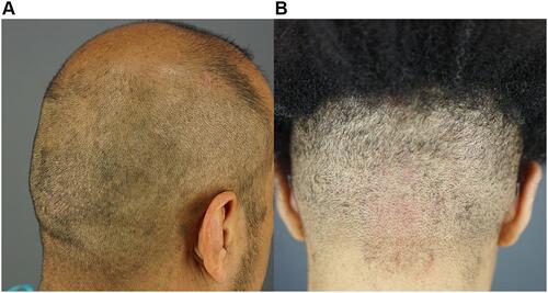 Figure 7 Examples of medium thickness/firmness scalps. Right posterior oblique view of patient 6 (Hispanic man) with medium scalp thickness/firmness (A). Posterior view of patient 8 (woman of African descent) with medium scalp thickness/firmness and curly hair (B).