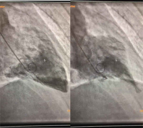 Figure 3. Left ventriculogram showing reverse ballooning during systole.