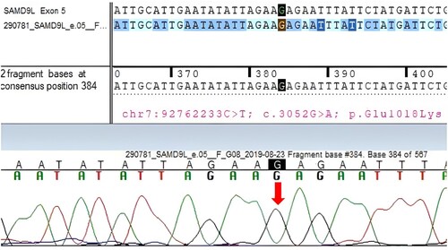 Figure 2. Sanger sequencing from a peripheral leukocyte blood sample using PCR showing the variation in exon 5 of the SAMD9L gene (chr7:g.92762233C>T; c.3052G>A; p.Glu1018Lys).
