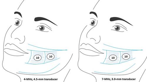 Figure 2 Second area delimited, the treatment is concentrated within two zones: anterior and posterior, which are narrower than the first area. The inclination of the transducer was oriented to perform the contraction in direction to the tragus.