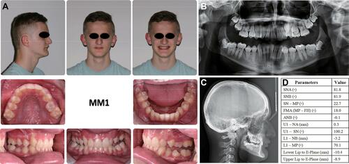 Figure 1 Pre-treatment records of patient MM1: (A) extraoral and intraoral photos; (B) panoramic radiograph; (C) cephalometric radiograph; (D) cephalometric measurements.