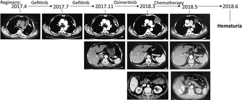 Figure 3. Computed tomography (CT) images recorded treatment-related changes of the patient