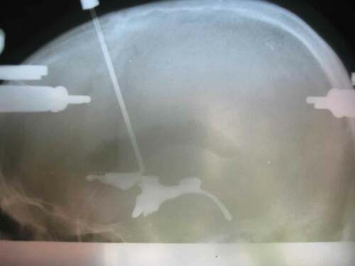 Figure 1. Pneumo-encephalogram with ventriculography demonstrating the ventricular and commissural anatomy where the radio-opaque dye is injected, complete with skull fixation pins (anterior and posterior on the skull).