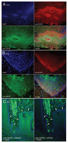 Figure 2 CIP2A/EGFR expression and localization in oral squamous cell carcinoma. CIP2A expression by immunofluorescence is highest in differentiated apical cell layers while EGFR expression is highest in basal cell layers. Serial tissue sections were co-stained with rabbit anti-CIP2A (green) and mouse anti-EGFR antibodies (red). Nuclei were counterstained with DAP I (blue). 100X (A) and 400X (B) magnification shown. (C) Specificity of anti-CIP2A staining demonstrated by absorption with recombinant CIP2A protein. Absorption was performed by pre-incubating rabbit anti-CIP2A antibodies with recombinant CIP2A or an unrelated protein giantin as a control. Immunofluorescence was then performed on serial tissue sections. Arrows indicate basement membrane. 100X magnification shown.