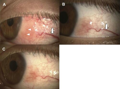 Figure 1 Slit-lamp biomicroscopic findings in Case 1. (A) Conjunctival tumor can be seen at the corneal limbus with edema and feeder vessel (arrow). A petechial pigmented lesion can be seen (arrowheads). (B) Photograph of eye one month after treatment with topical epinastine and tacrolimus, an immunosuppressive drug. The tumor size and edema are markedly reduced, and the feeder vessel has regressed (arrow). (C) One year after the treatment. The tumor is not detectable.