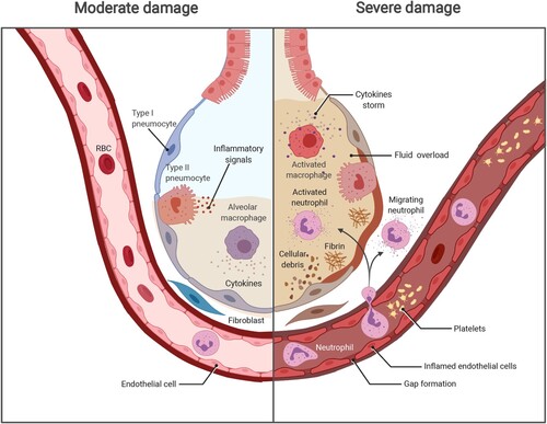 Figure 1. The progression of COVID-19 and potential damage. Left, SARS-CoV-2 infects the human airway epithelium via ACE2 receptors, which are mainly located on type II pneumocytes. In mild disease, the recruitment of myeloid cells occurs without causing an inflammatory storm, and the virus is cleared. Right, in severe COVID-19, SARS-CoV-2 escapes from the immune system, penetrates the epithelium, and infects endothelial cells that induce cell debris. Severe COVID-19 involves diffuse alveolar damage, endotheliitis, and fluid overload associated with neutrophils originated cytokine storm and NETs. The image was created with BioRender.com.