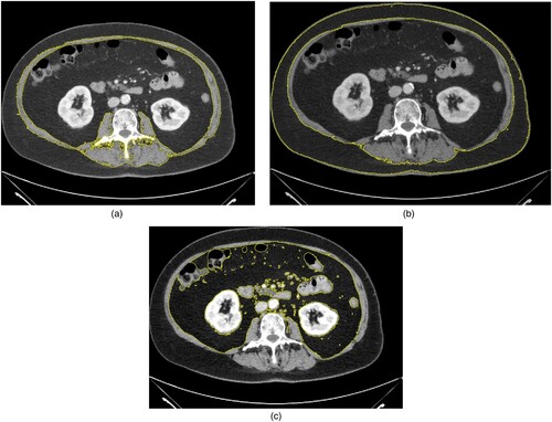 Figure 1. Explanatory patient of the patient sample. The region of interest is drawn to measure the skeletal muscle area (a), (b) subcutaneous fat area, and (c) visceral fat area. The patient was sarcopenic and was visceral obese with a VAT of 120 cm².