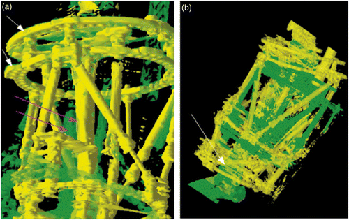 Figure 2. (a) The top frames (white arrows) for patient 1 are nicely aligned (green and yellow frame surfaces coincide), but the proximal tibia (magenta arrows) is not aligned (yellow: original CT-A volume from first scan date; green: original CT-B volume from second scan date after registration–FVOL-1). The top frame and pins were moved between the first (CT-A) and second (CT-B) scans. (b) The distal tibia is now well aligned (white arrow). Bony landmarks were used on the original CT-A and CT-B volumes to register the proximal tibia, and the resulting fused volume (FVOL-2) was used together with bony landmarks on the original CT-A volume to register the distal tibia, resulting in FVOL-3 (yellow: FVOL-3; green: original CT-A volume from first scan date).