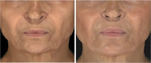 Figure 3 Patient at baseline (left) and Week 8 after receiving two SP-HA injections in the face (right).