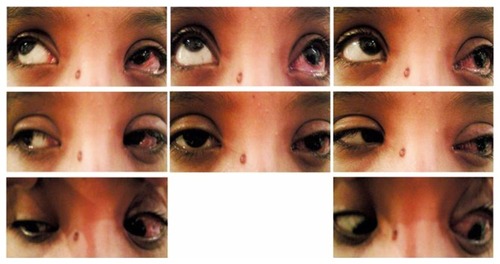 Figure 4 Postoperative pictures of Case 8 (1 week after single-stage adjustable strabismus surgery) with residual ptosis due to lid edema.