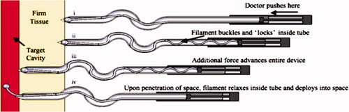 Figure 26. Flexible puncture needle with mechanical clutch device.