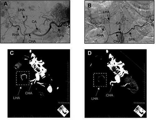 Figure 2 Impact of SOR on normal blood vessels. DSA images of a representative case. (A) before SOR administration and (B) 3 months after SOR administration. 3D images of the vascular structure reconstructed from CT images (C) before SOR administration and (D) 3 months after SOR administration.Abbreviations: DSA, digital subtraction angiography; SOR, sorafenib; CT, computed tomography; CHA, common hepatic artery; RHA, right hepatic artery; LHA, left hepatic artery; SPA, splenic artery; CA, celiac artery.