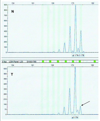 Figure 2. Representative example of LOH analyses of PTEN tumor suppressor gene with D10S1765 microsatellite marker, showing loss of allele 178 (arrow) in tumor sample (T) compared with its normal counterpart (N).