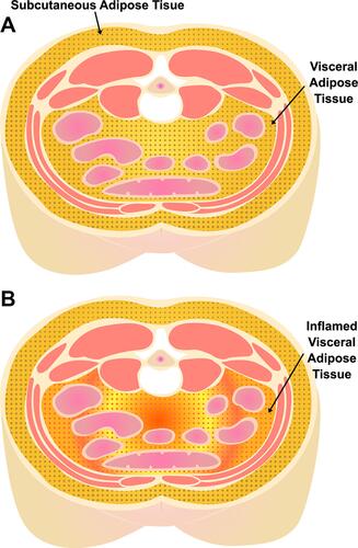 Figure 1 Visceral (VAT) and subcutaneous (SAT) adipose tissue depots. (A) Subcutaneous and visceral adipose tissue depots in the abdomen. (B) Pathologic/inflamed visceral adipose tissue.