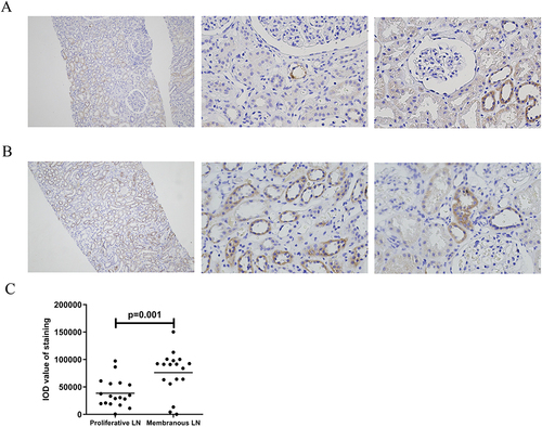 Figure 1 MPC1 expression in kidney tissues of LN. Representative immunohistochemical staining of MPC1 in proliferative LN ((A), n=18), and membranous LN ((B), n=18) groups, respectively. Left column (Magnification×100). Right two columns (Magnification×400). (C) shows a comparison of quantitative analysis of MPC1 expression between proliferative LN and membranous LN using Image-Pro Plus 6.0 software.