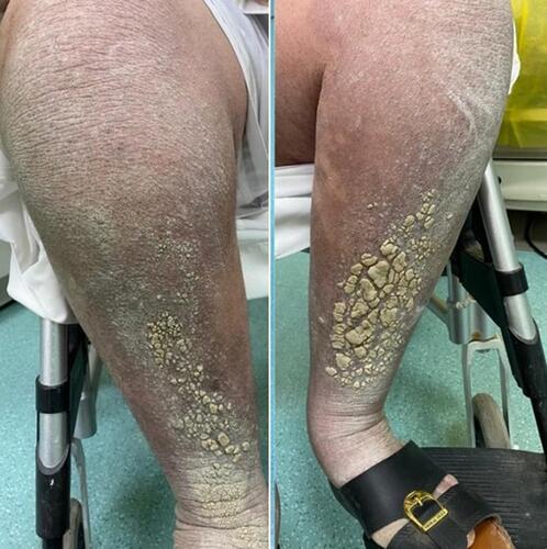 Figure 2 Significant improvement in psoriatic lesions after treatment with adalimumab.