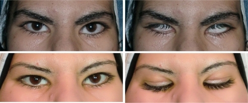 Figure 3 Patient with high level of insertion of gold plate, preoperatively with eye open (above left), preoperatively with eye closed (above right), postoperatively with eye open (below left), and postoperatively with eye closed (below right).