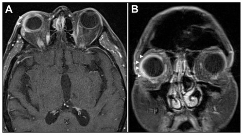Figure 3 Contrast-enhanced FS axial and coronal T1-weighted images (A, B) reveal enhancement of the uveal tract and the subchoroidal abscess on the right along with preseptal edema. Also note the extension into the retrobulbar fat and extra-ocular muscles, outlining the extent of the inflammatory process.