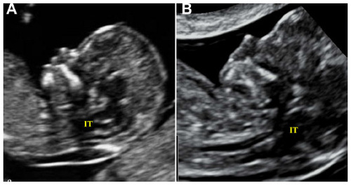 Figure 3 Internal translucency (IT) in normal fetus (A) and in a fetus affected by spina bifida (B).