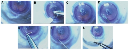 Figure 3 The first segment was inserted completely (A). The second segment was passed through the same side of the incision and used to push the first segment through the channel (B). The needle of a double armed 9-0 nylon suture was then passed through the second segment inferior islet (B). The second segment inferior islet was then engaged with a Sinskey hook and advanced (C). By passing the Sinskey hook through the other side of the channel, the first segment inferior islet is engaged (D), and the islet is pulled out of the wound (E). The other arm of the 9-0 nylon is then passed through the posterior surface of the islet of the first segment with attention not to allow the suture to cross or twist (E). The segments are then positioned to be equidistant from the incision (F) and then a surgical knot is thrown with the desired tension (G).