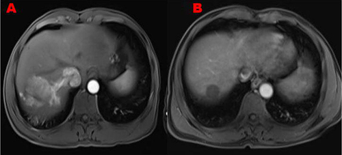 Figure 3 Case 2, a 55-year-old male who sequentially underwent transarterial chemoembolization and sorafenib treatment. (A)The arterial phase CT image 8 days prior to rego-pd-1 treatment showed a large HCC mass with inhomogeneous enhancement at segment 7, tumor thrombus was observed in right hepatic vein and inferior vena cava. (B) Arterial phase CT imaging of case 2 at 4 months after initiation of rego-pd-1 treatment showed significant shrinkage and no enhancement of the HCC.