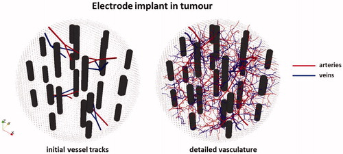 Figure 4. 3D representation of the modelled tumour volume with a 12 dual-electrode implant, together with the initial discrete vasculature (left) and the complete artificially generated detailed vasculature (right).