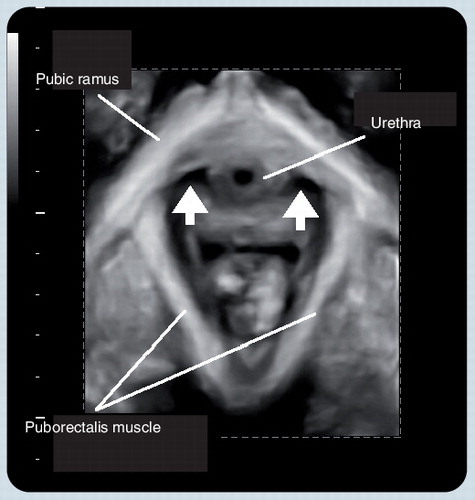 Figure 3. The appearance of the puborectalis muscle in a rendered volume in the axial plane, using translabial 3D ultrasound with speckle reduction imaging.The two arrows indicate the gap between urethra and puborectalis insertion that can conveniently be palpated to determine muscle integrity.Reproduced with permission from Citation[61].