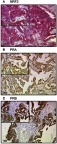 Figure 1 Detection of NRF2 and PRA/PRB with immunohistochemistry.Notes: High cytoplasmic NRF2 staining (A) corresponds with high PRA (B) and high PRB (C) staining found in specimens from the same individual. NRF2 cytoplasmic expression correlated with PRA (cc=0.247, p=0.003) and PRB expression (cc=0.25, p=0.003). Abbreviations: cc, correlation coefficient, p = two-tailed significance.