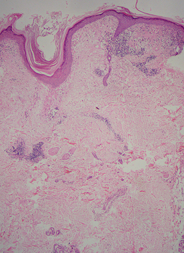 Figure 7 Histopathology of scalp discoid lupus erythematosus shows follicular dilatation, plugging, and perifollicular and interfollicular dilated vessels (H & E, X50).